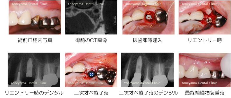 インプラント症例
