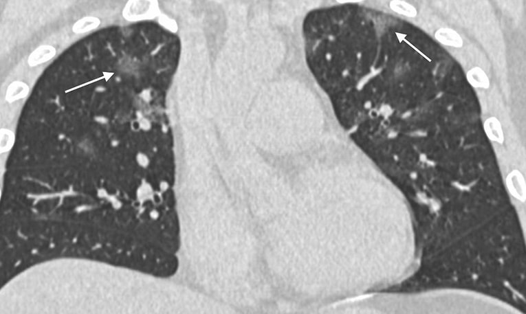 肺炎CT像